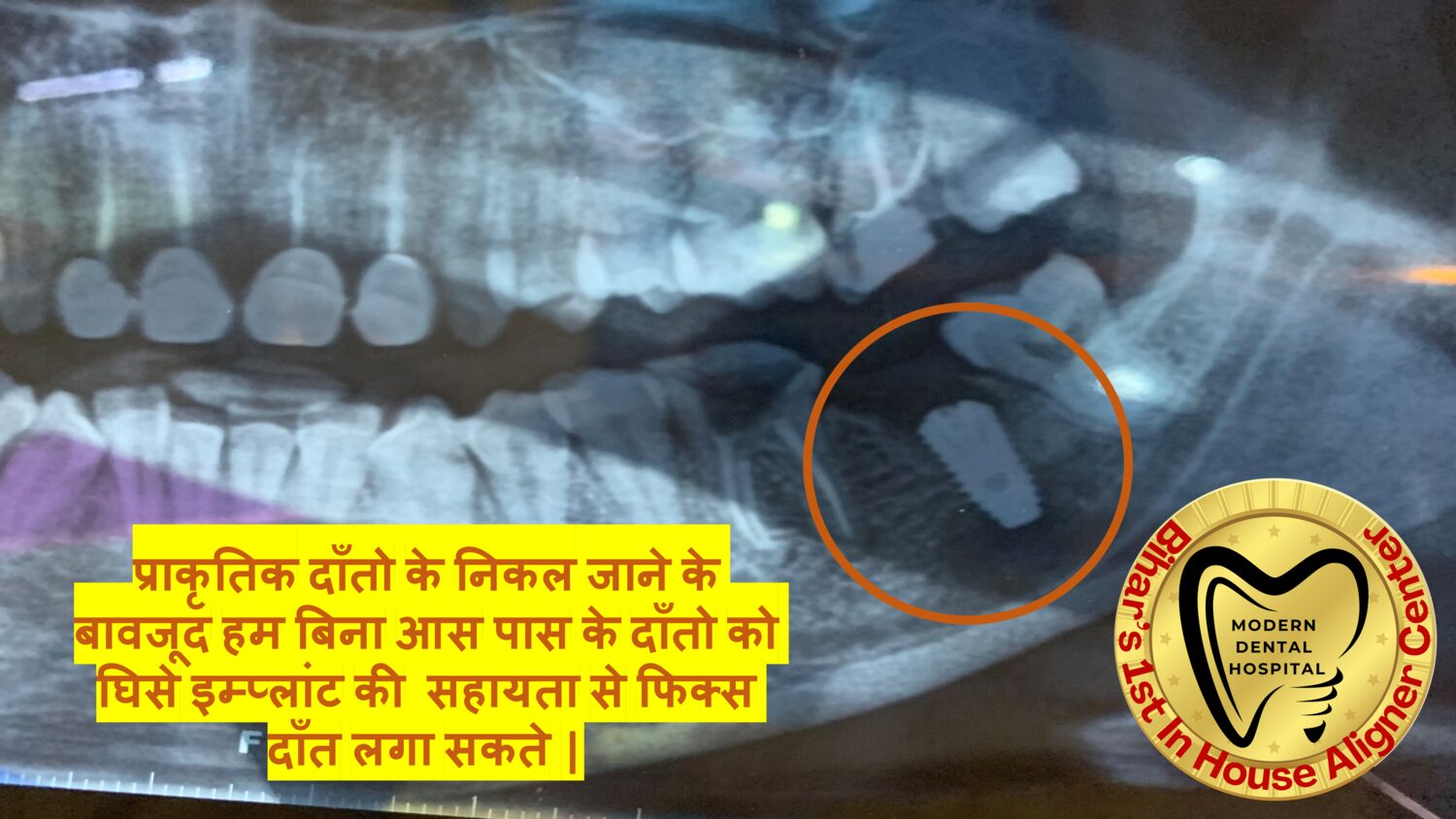 Dental implant X-ray for a back tooth in Patna